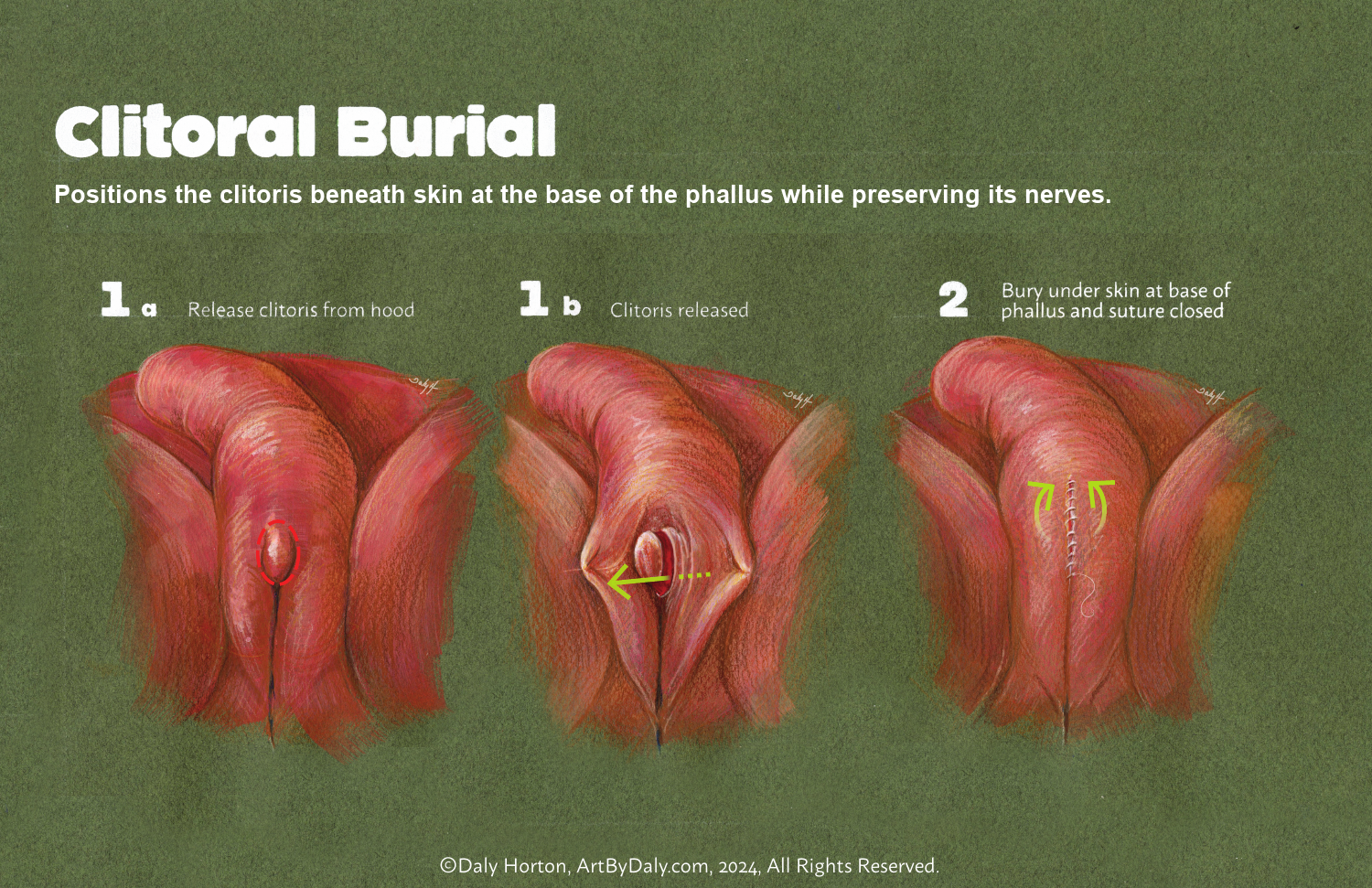 Schematic showing positioning of the clitoris beneath tissue at the base of the phallus.