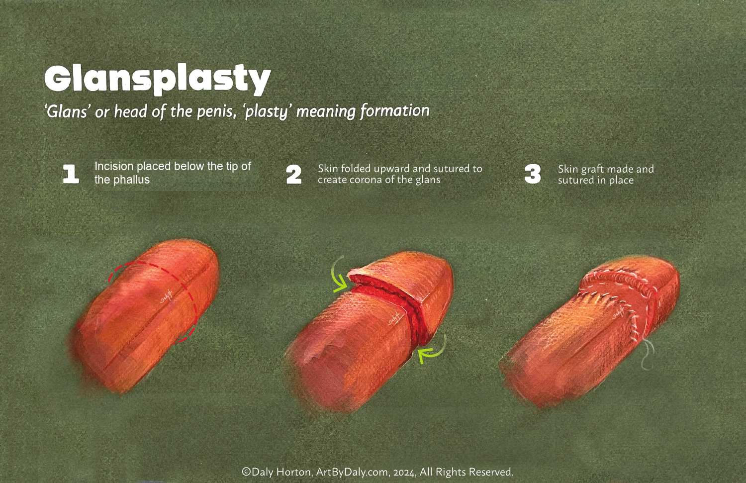 Schematic of folding tissue and placing a graft to shape the glans.