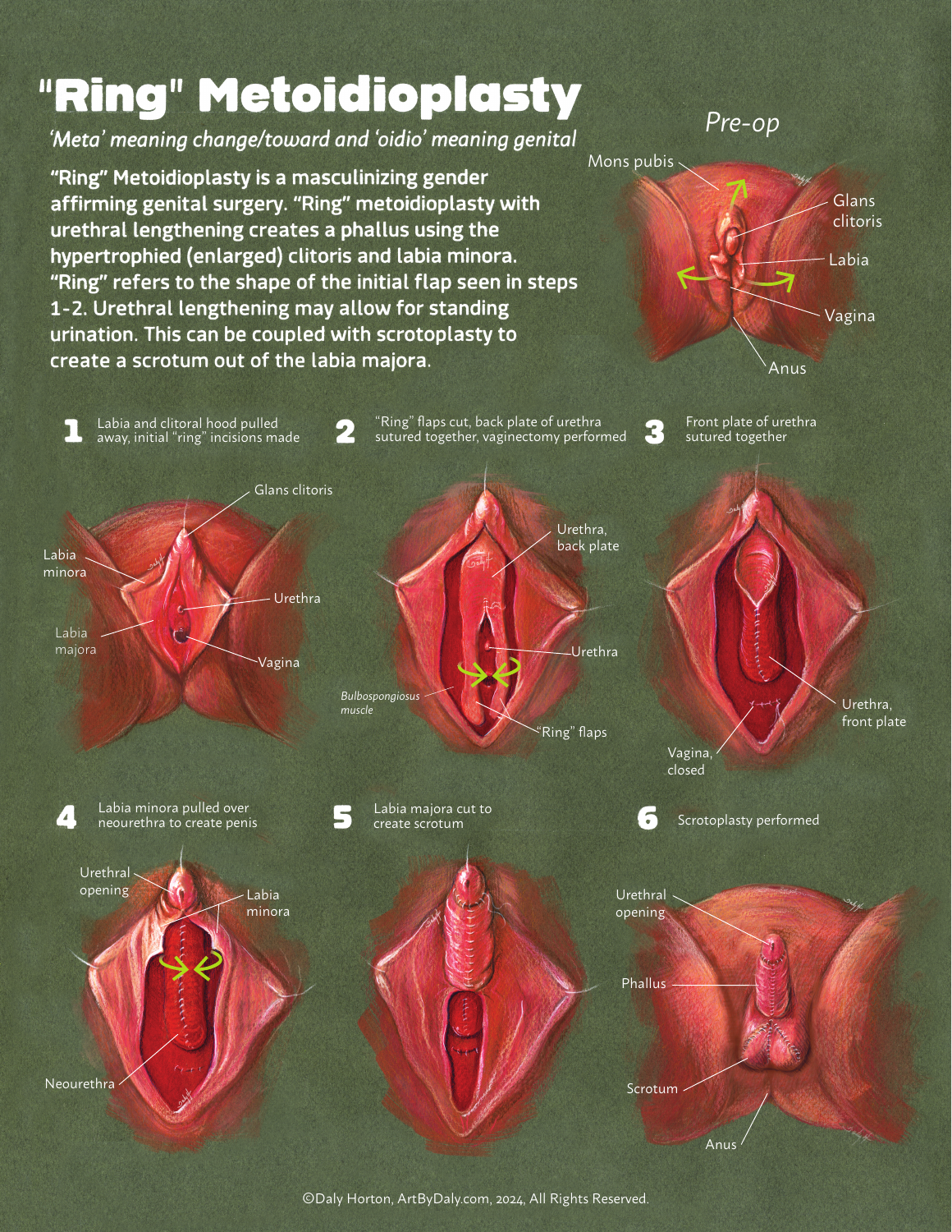 Ring metoidioplasty schematic showing release of genital tissue, construction of a urethra and scrotal reconstruction.