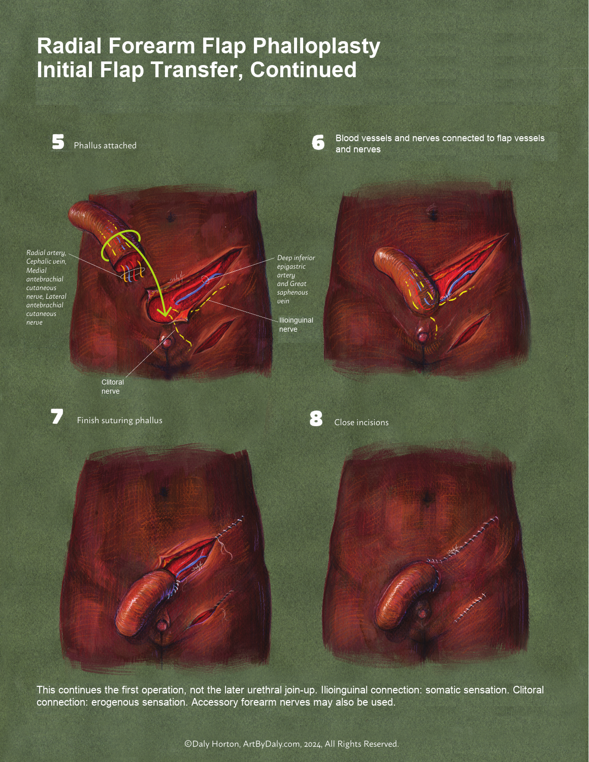 Schematic of attachment of the phallus, connection of blood vessels and nerves, and closure.