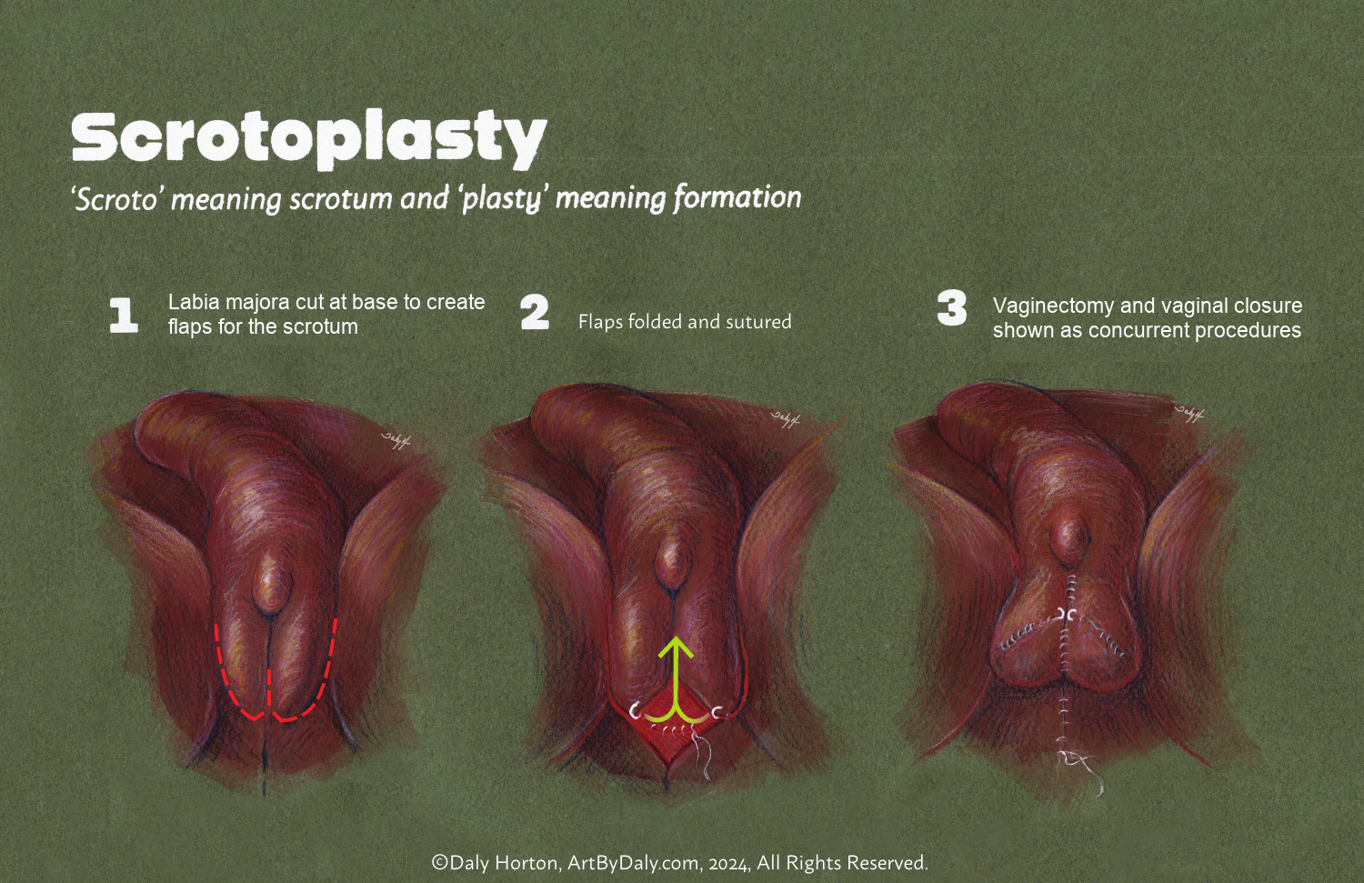 Schematic showing labial tissue reshaped into a scrotum; the poster also depicts vaginal closure.