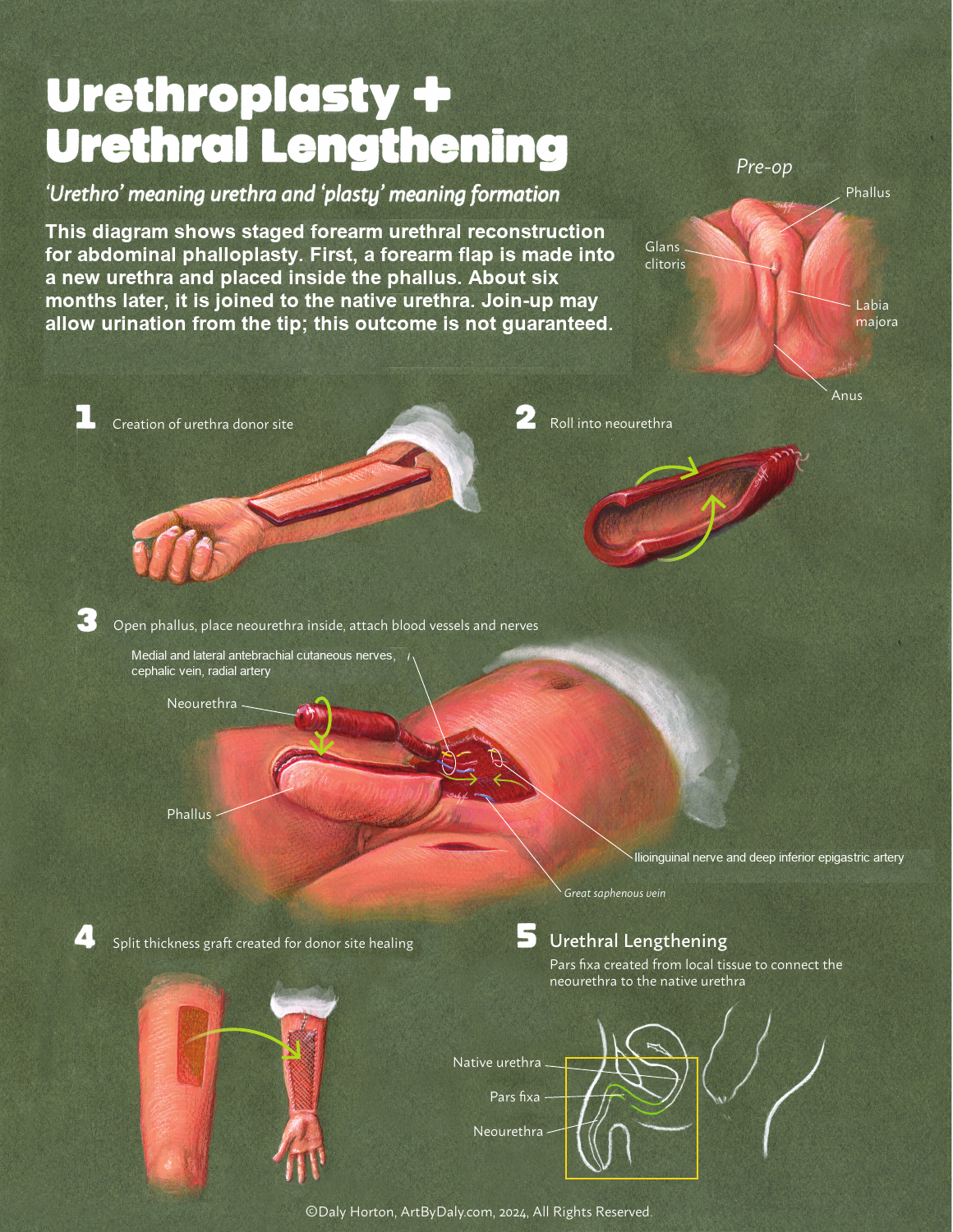 Schematic of constructing a urinary channel from forearm tissue and connecting it to the existing urethra.
