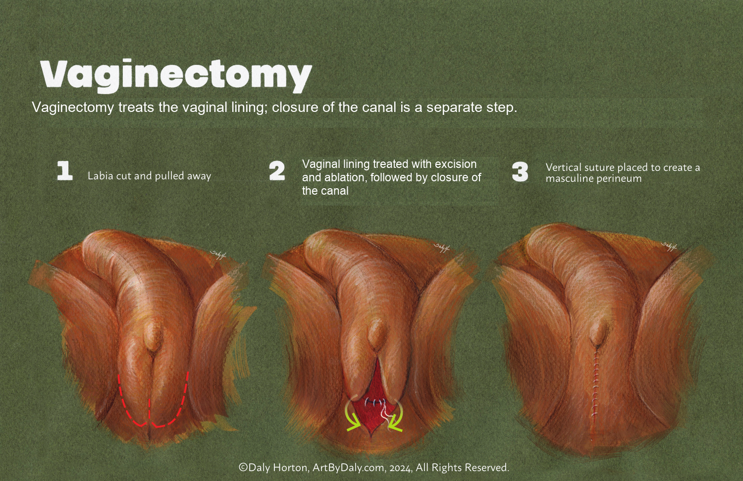 Schematic of vaginal closure and perineal reconstruction.