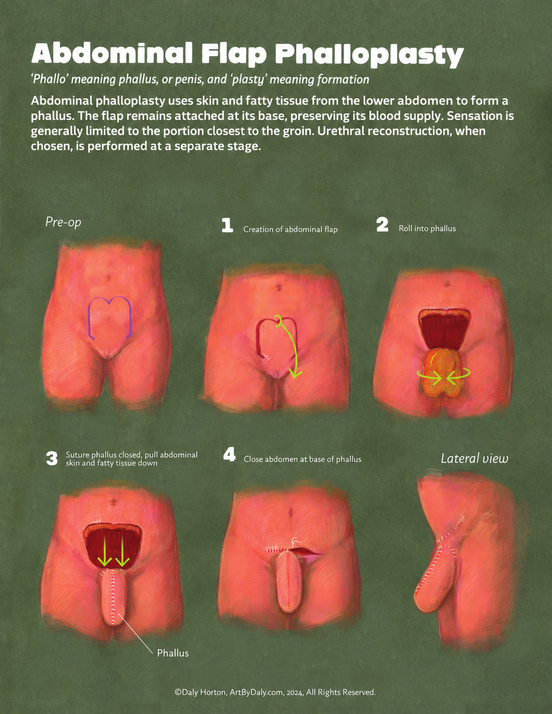 Abdominal flap phalloplasty schematic showing a lower abdominal flap marked, raised, rolled into a phallus, and the abdominal skin brought down for closure.